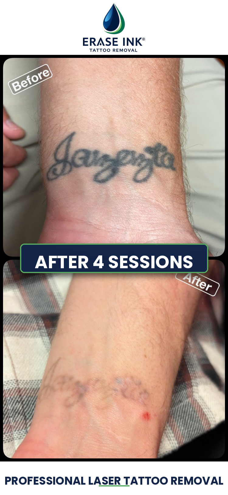 Tattoo removal near Clarkston