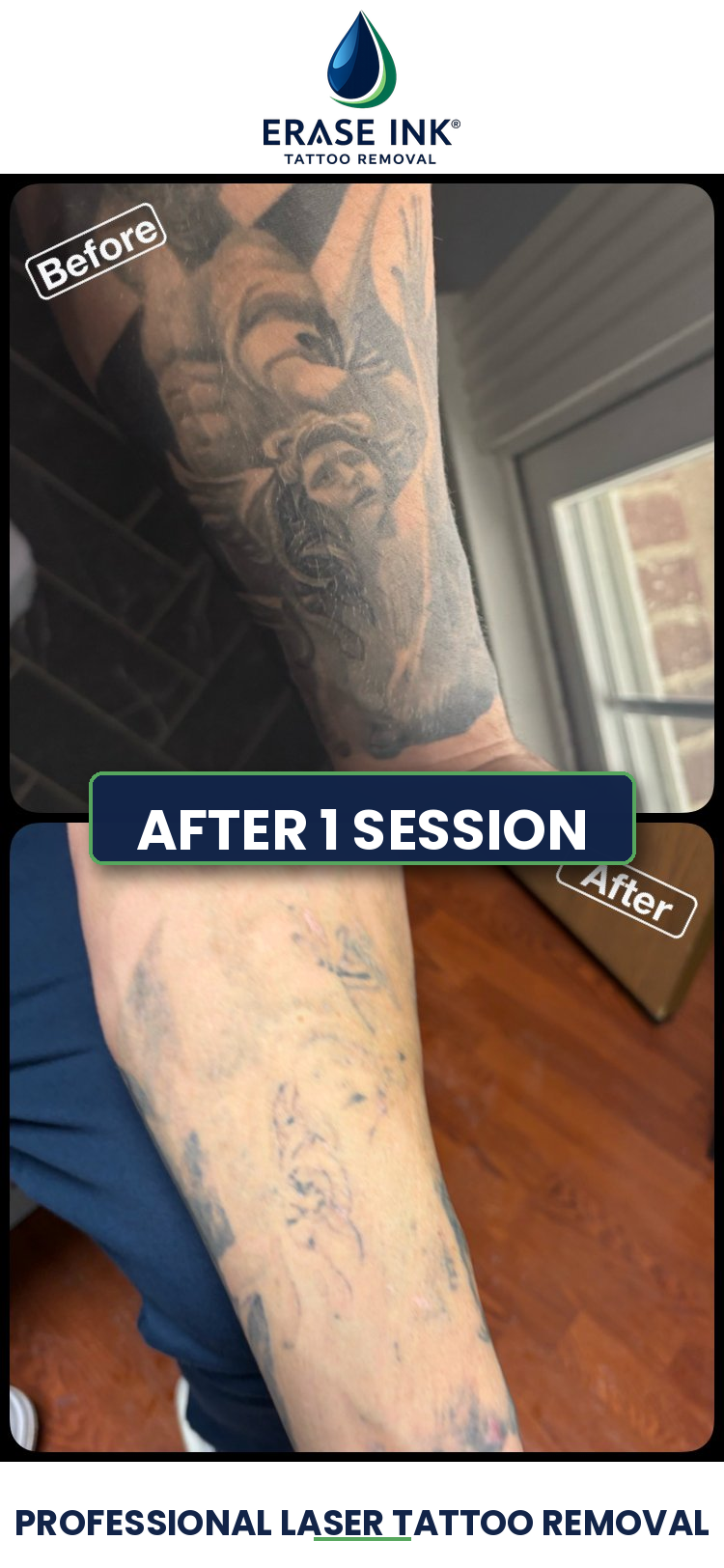 Before and after tattoo removal