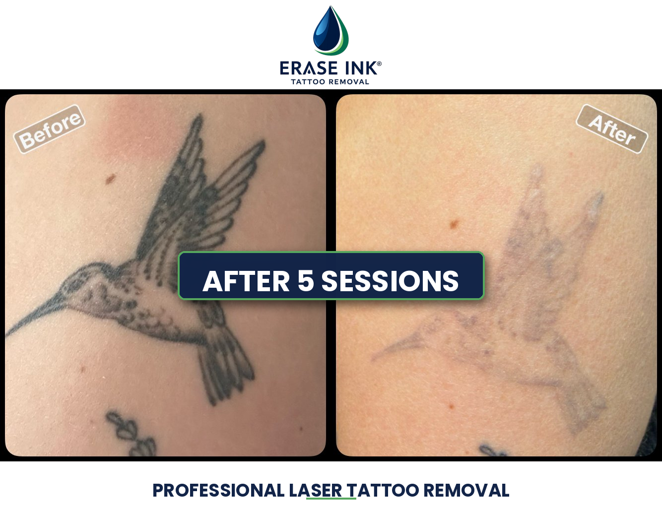 Before and after full removal large tattoo