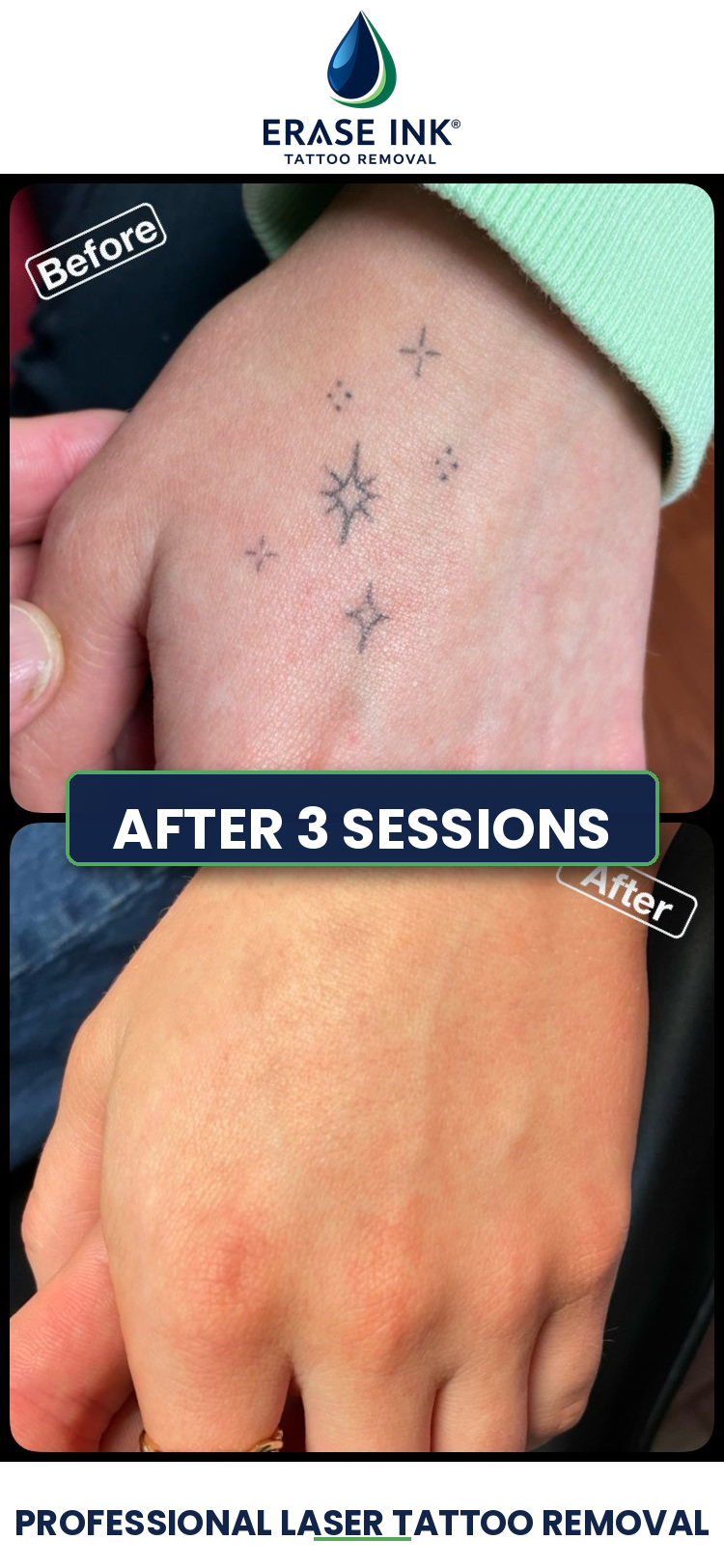 Tattoo removal near Clarkston
