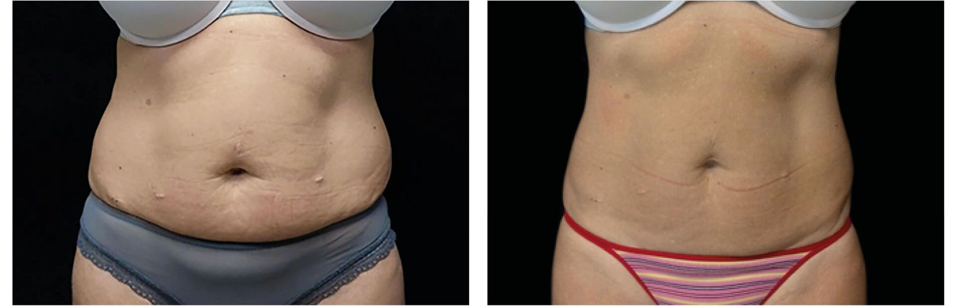 XTONE before and after — result 03