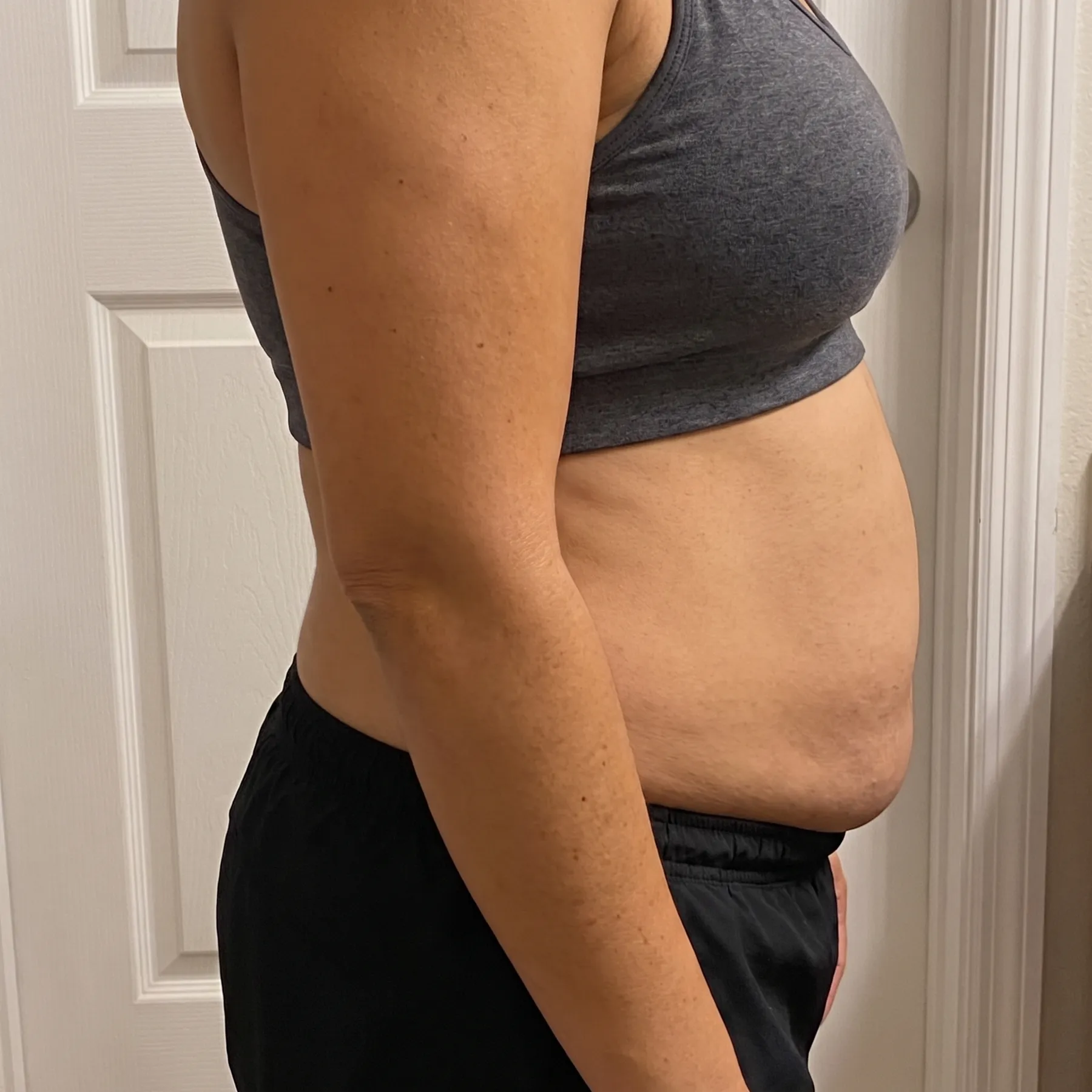 Before: client's midsection prior to Cryoskin treatment