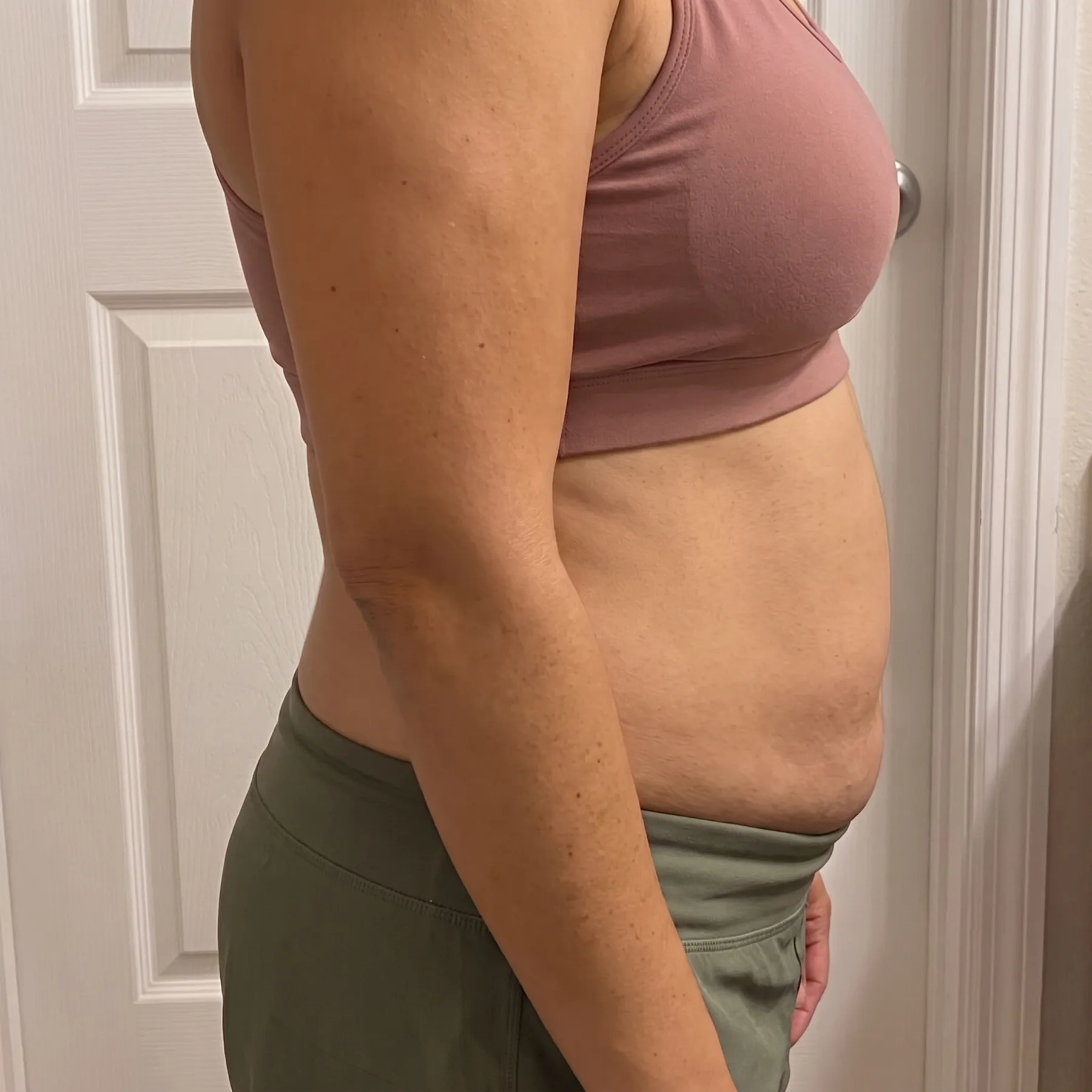 After: client's midsection following a Cryoskin series