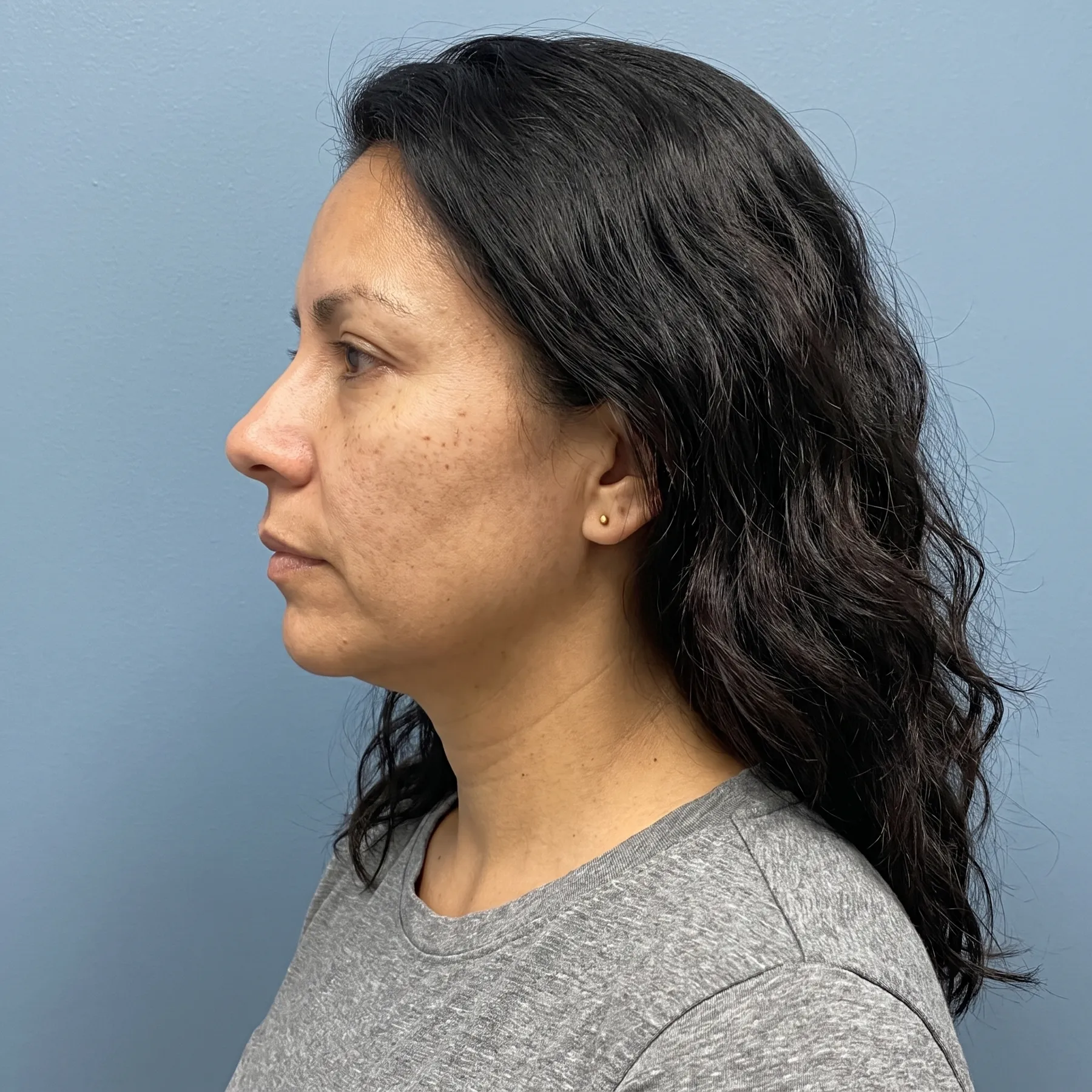 Before: client's neck and jawline prior to Cryoskin treatment