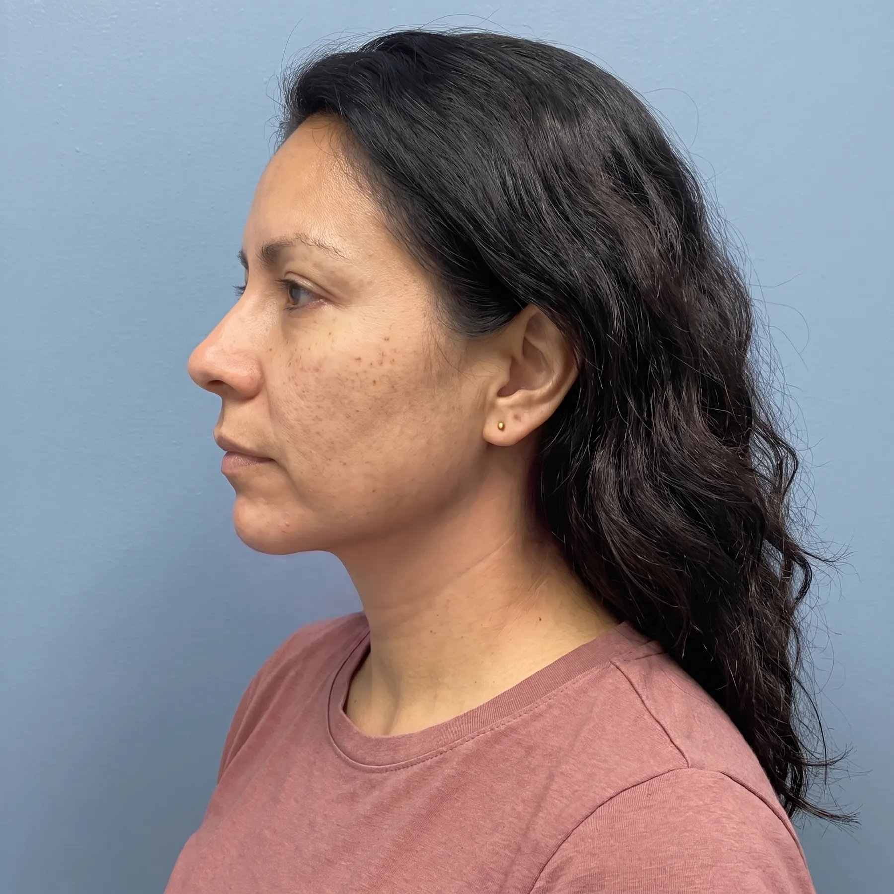 After: client's neck and jawline following a Cryoskin series