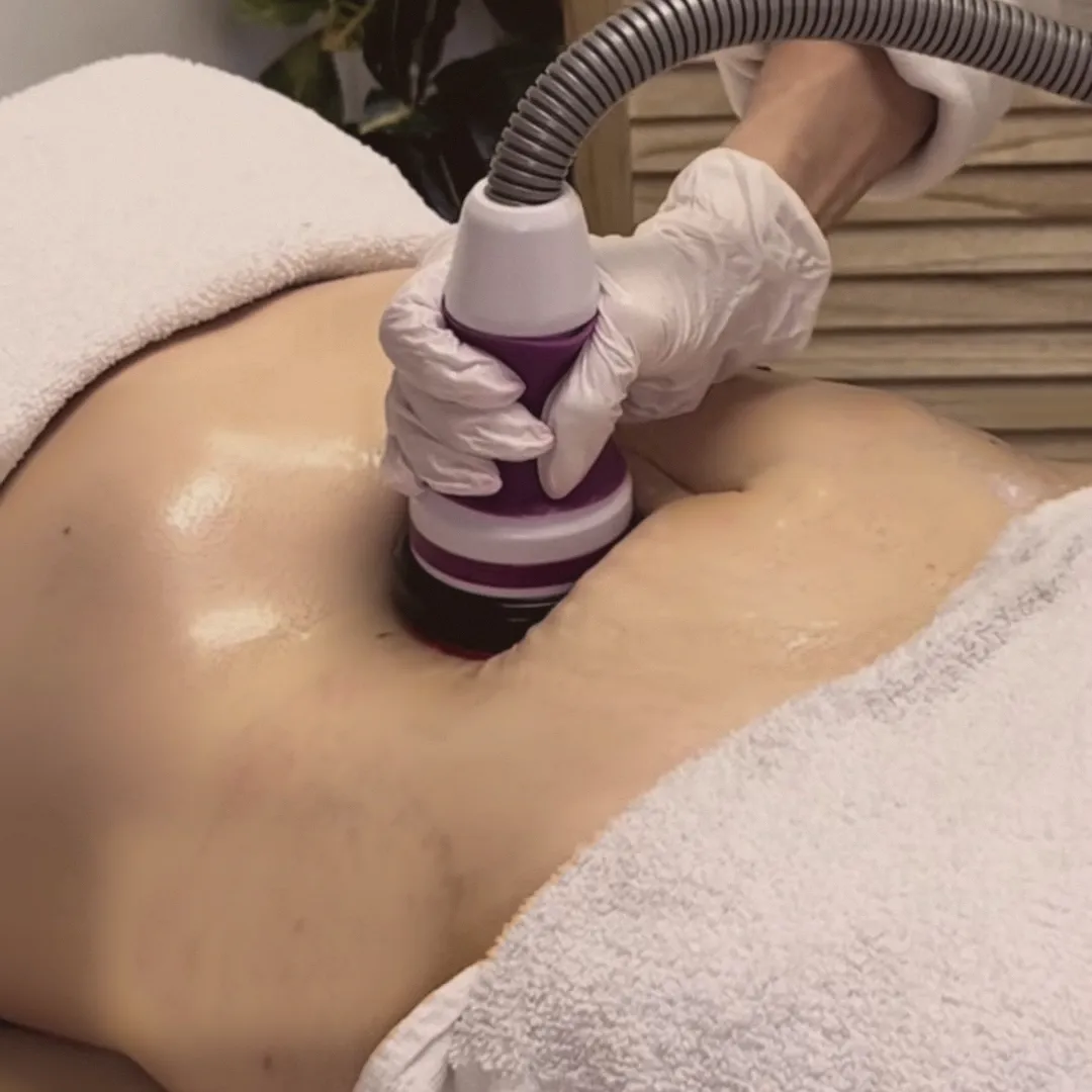 Gloved hands preparing a Cryoskin applicator beside a treatment bed, seen from above