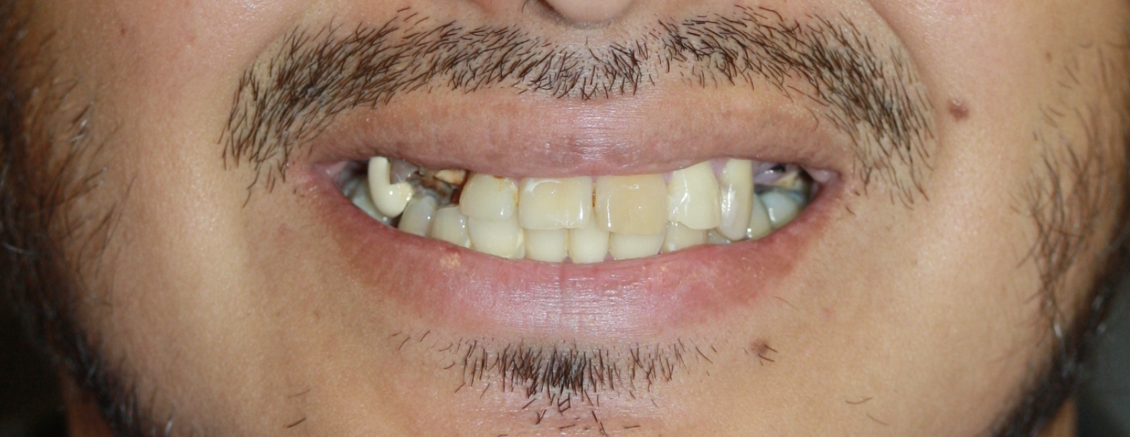 Before