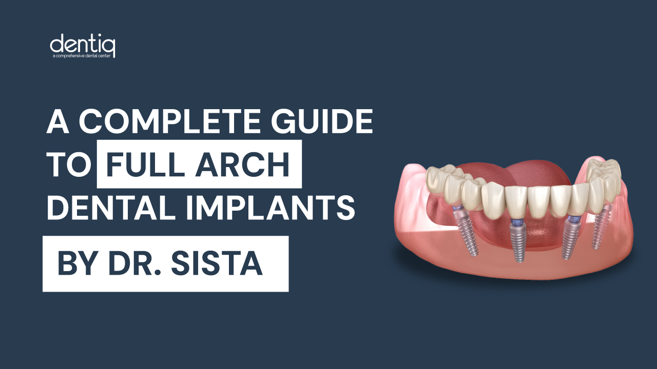 Full Arch Dental Implants Houston