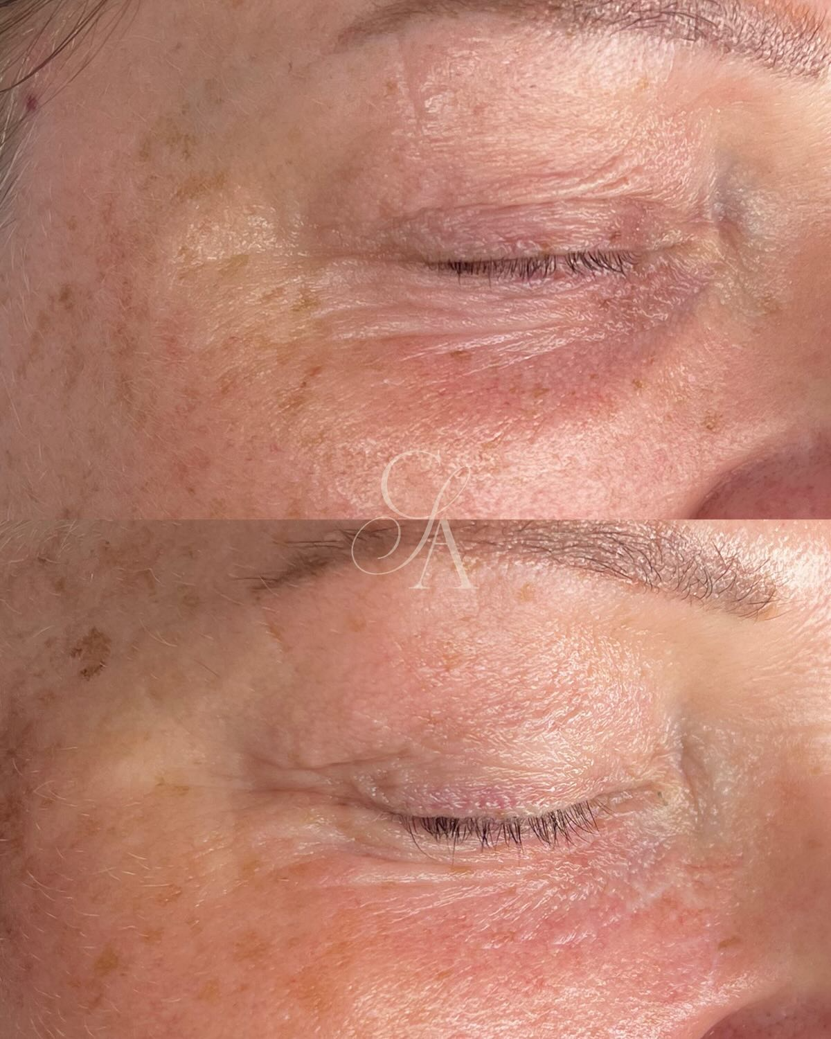 Before and after, real client skin result