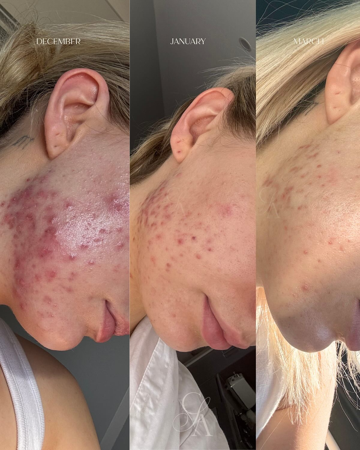 Before and after, real client skin result