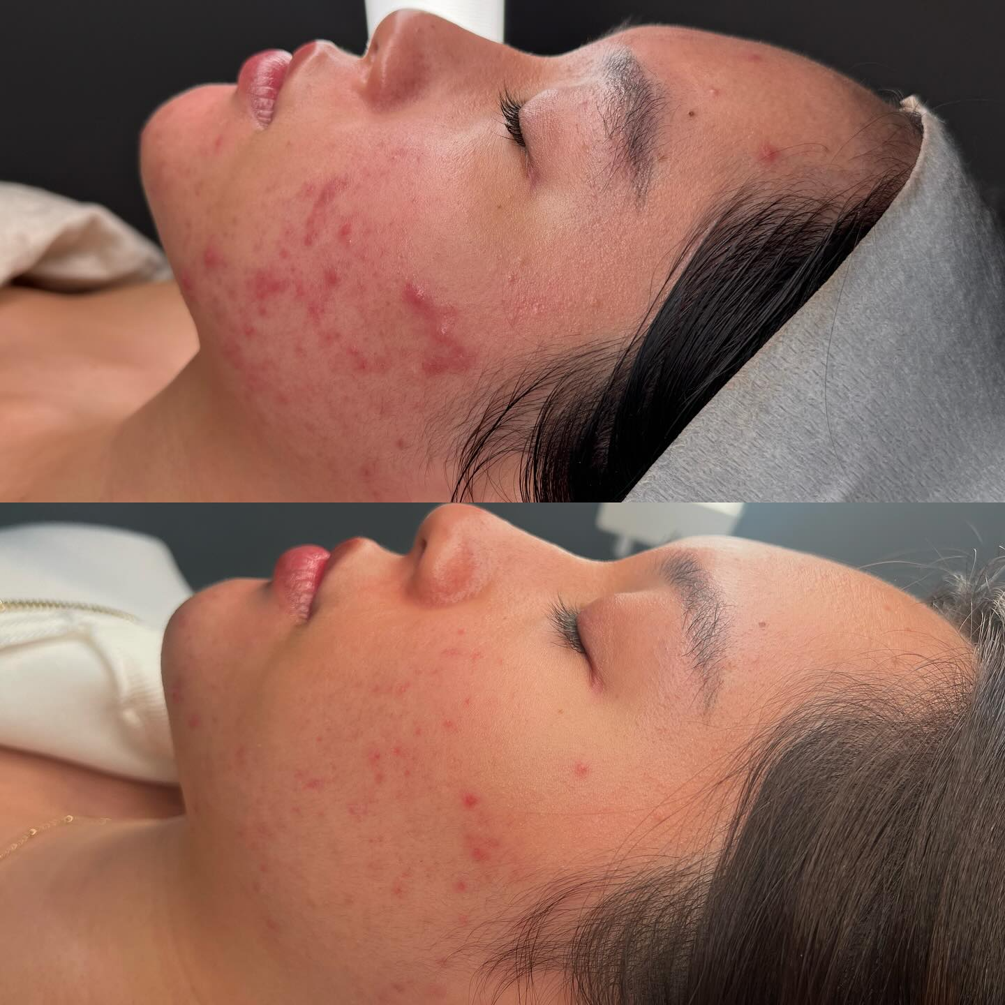 Client skin result 16 before and after treatment at Curated Skin Aesthetics