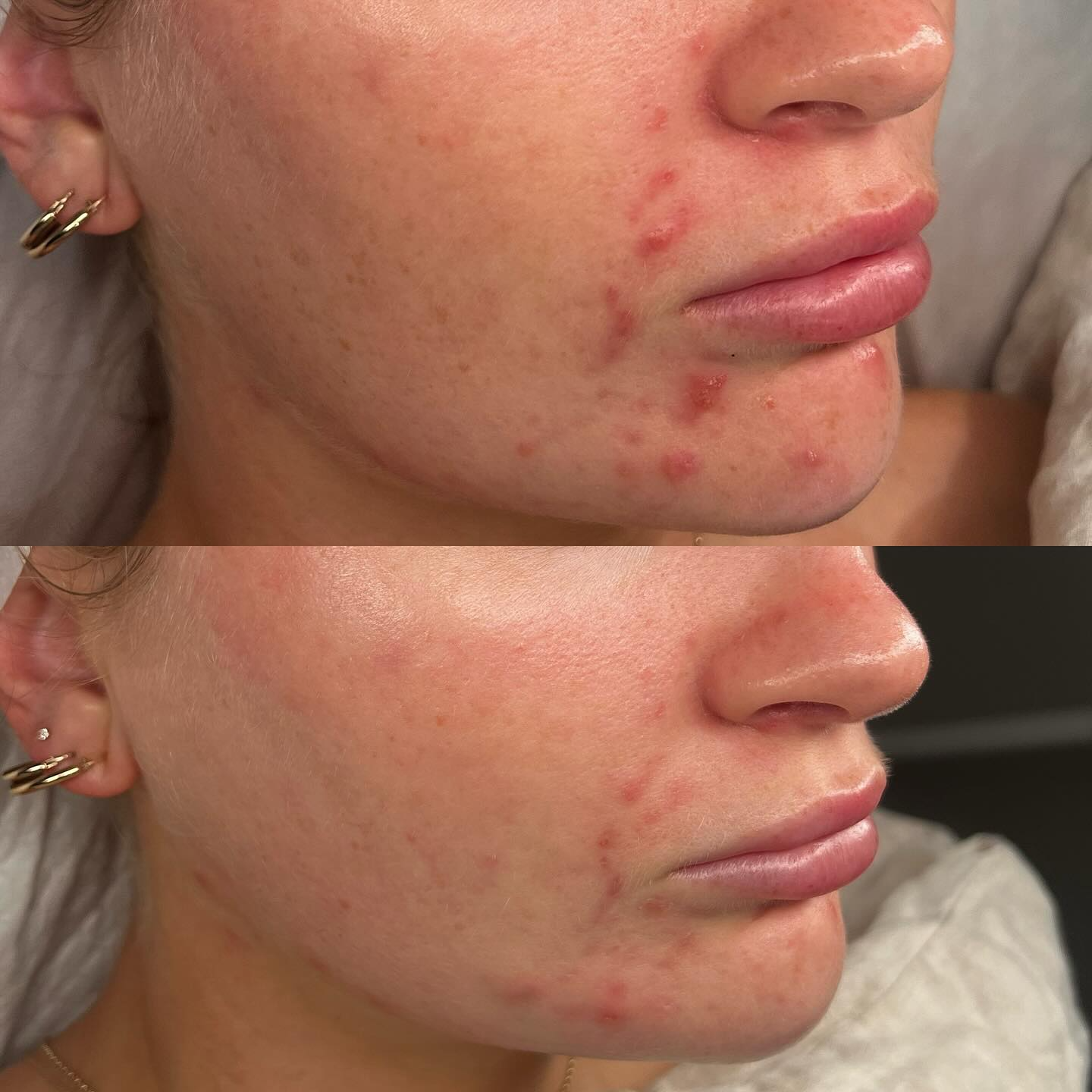 Client skin result 14 before and after treatment at Curated Skin Aesthetics