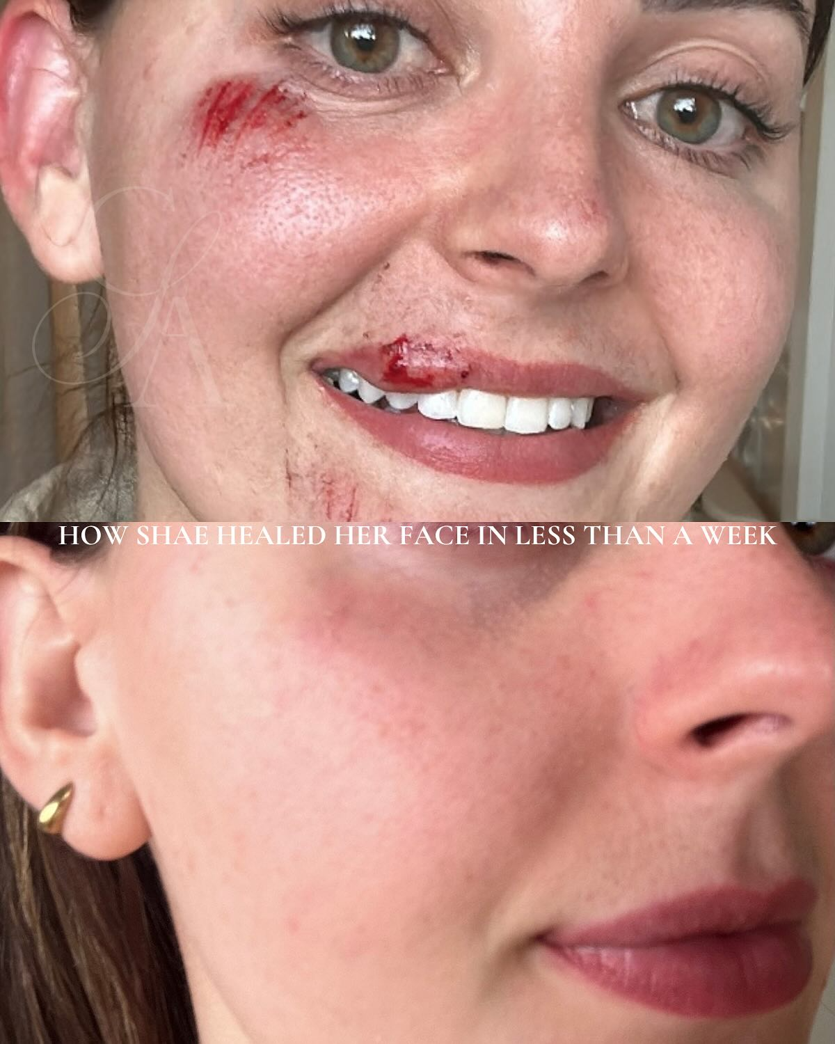 Before and after, real client skin result