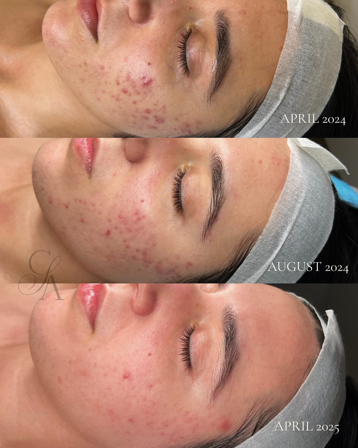 Before and after, real client skin result