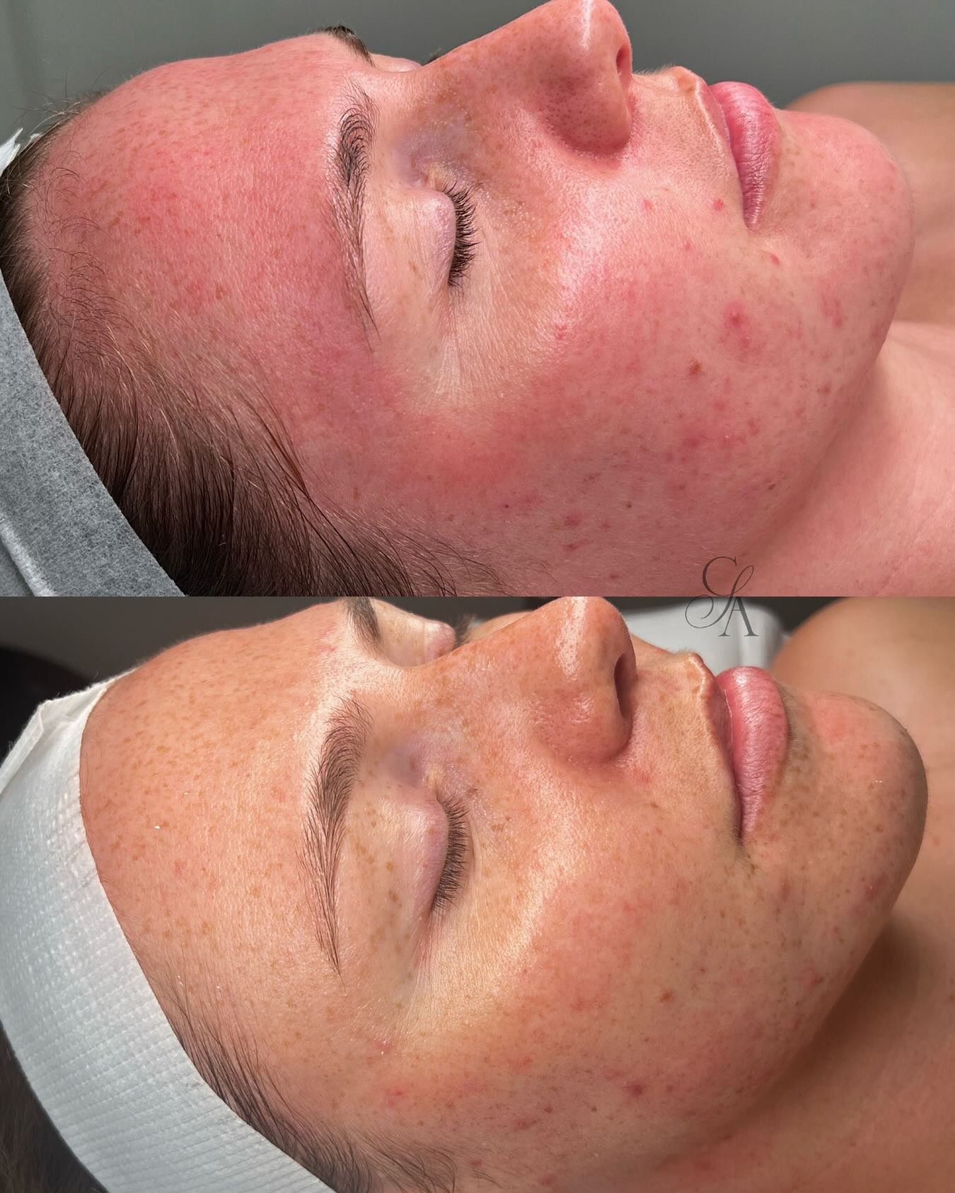 Client skin result 15 before and after treatment at Curated Skin Aesthetics