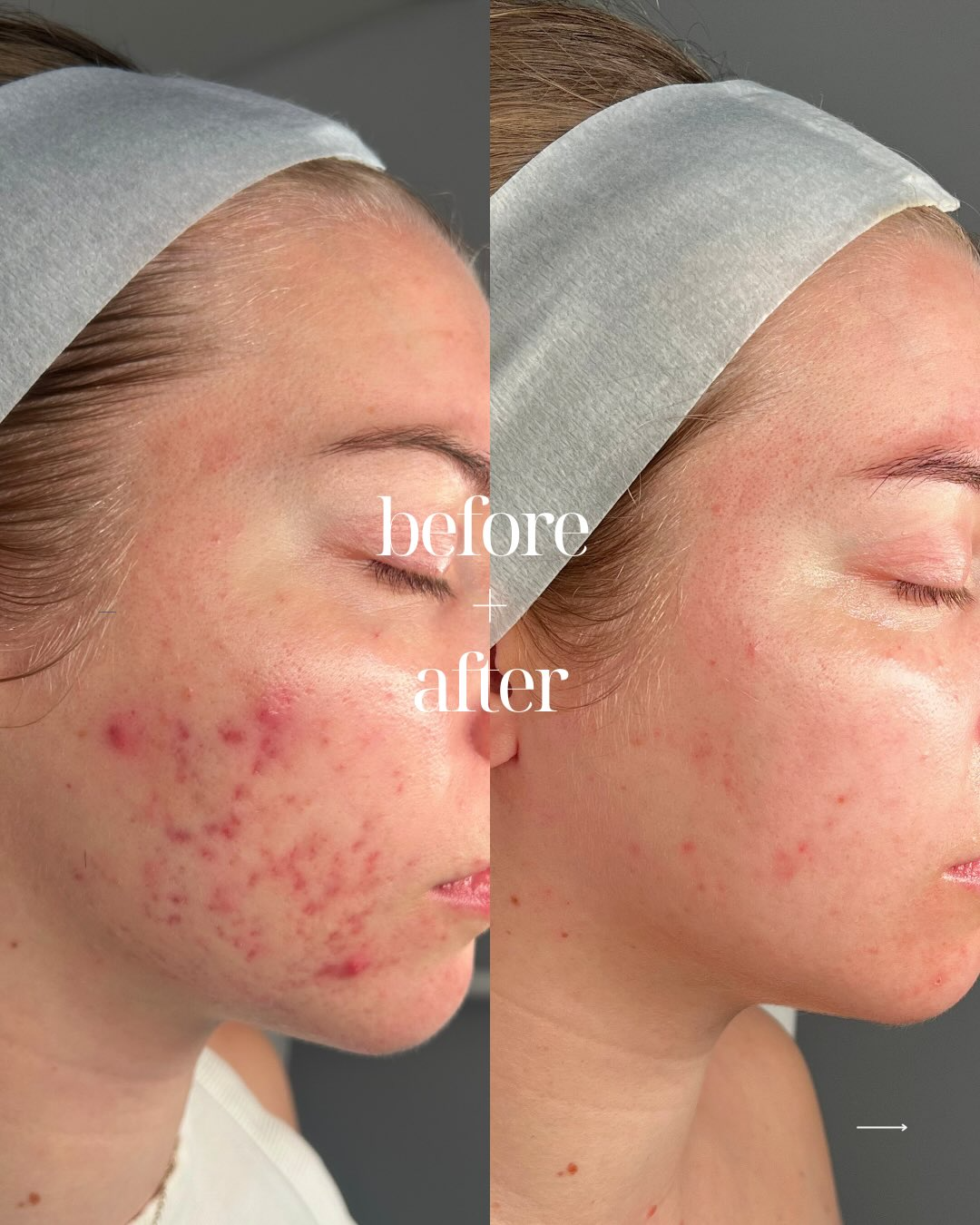 Client skin result 12 before and after treatment at Curated Skin Aesthetics