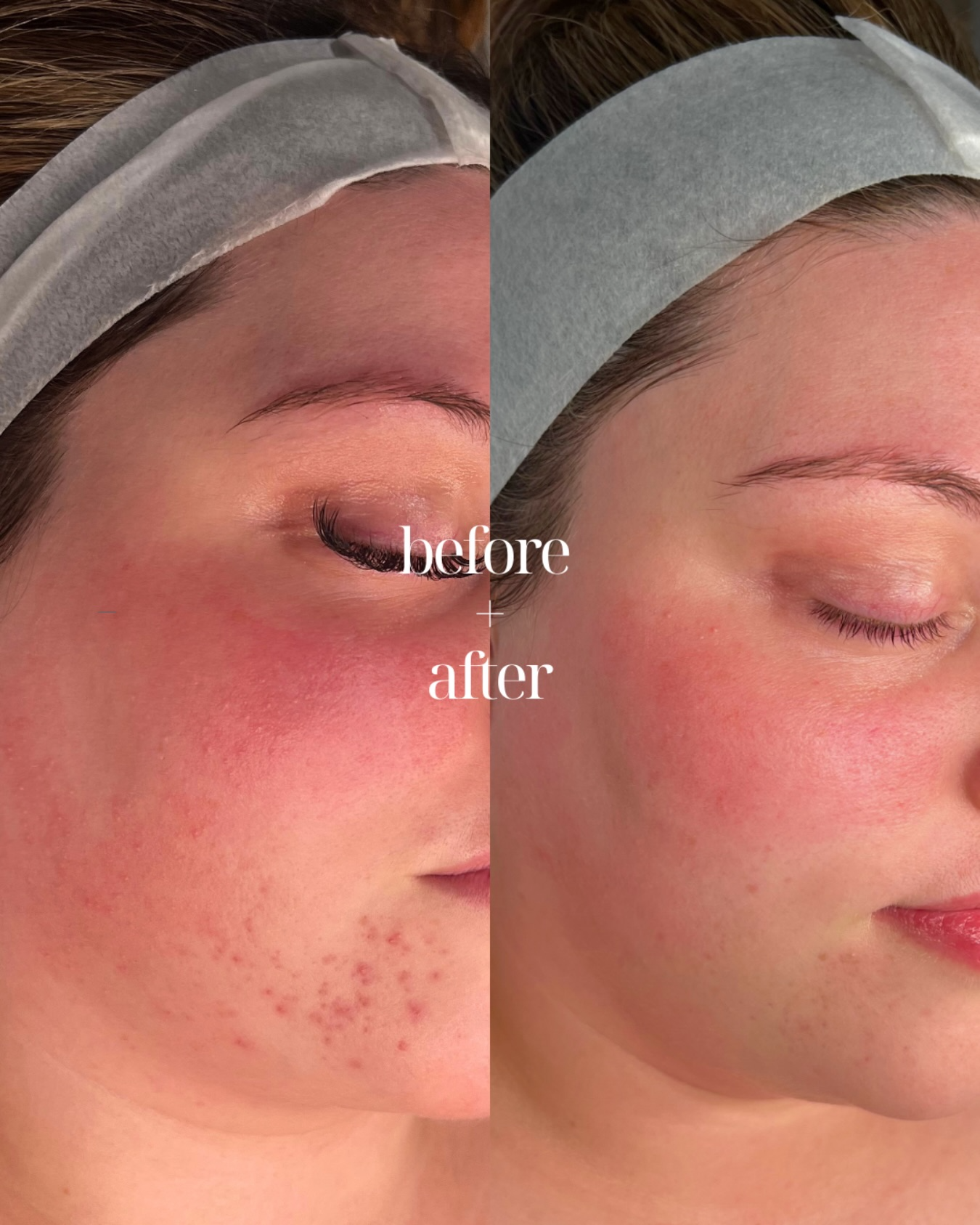 Client skin result 11 before and after treatment at Curated Skin Aesthetics
