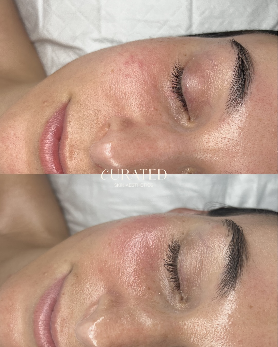 Client skin result 8 before and after treatment at Curated Skin Aesthetics