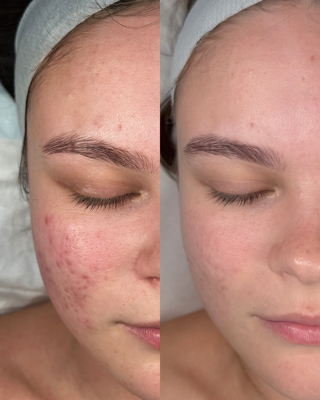 Client skin result 10 before and after treatment at Curated Skin Aesthetics