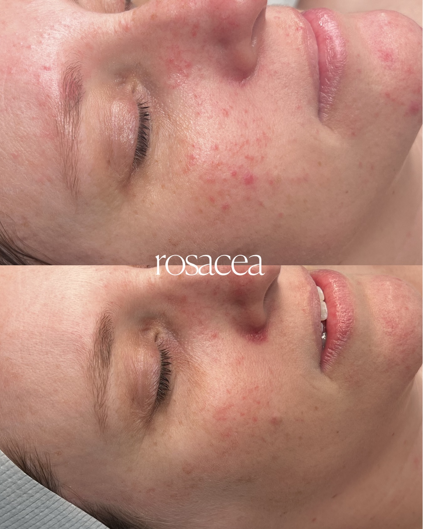 Client skin result 9 before and after treatment at Curated Skin Aesthetics