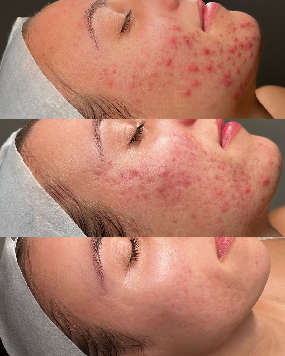 Client skin result 6 before and after treatment at Curated Skin Aesthetics