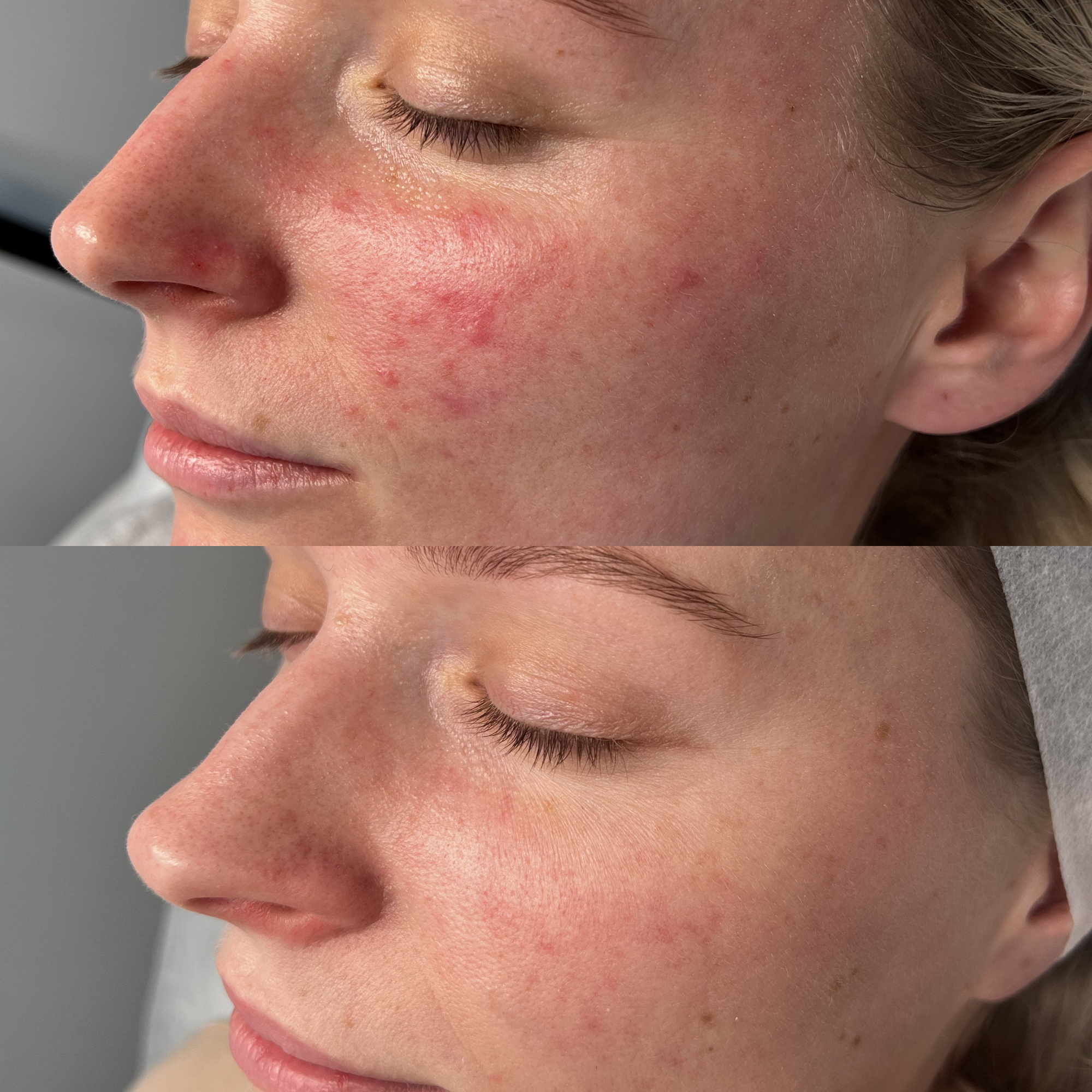 Client skin result 4 before and after treatment at Curated Skin Aesthetics
