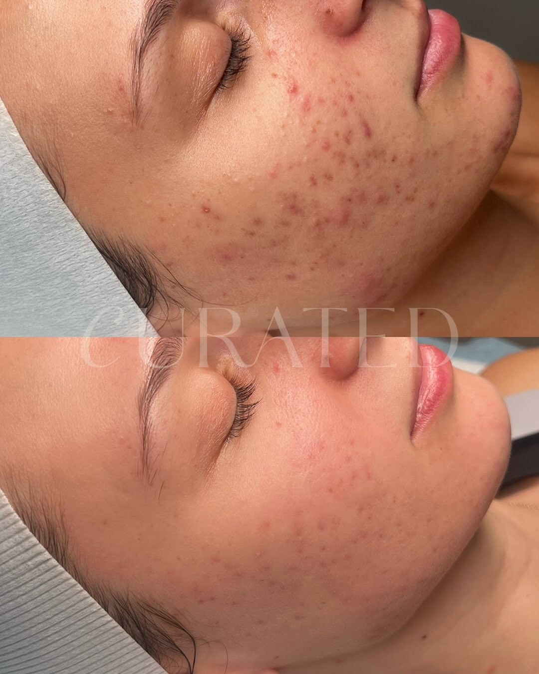 Client skin result 7 before and after treatment at Curated Skin Aesthetics