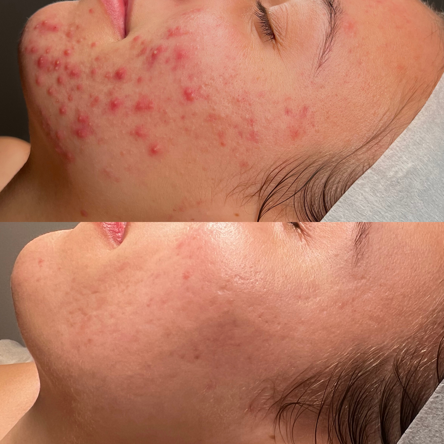 Client skin result 2 before and after treatment at Curated Skin Aesthetics
