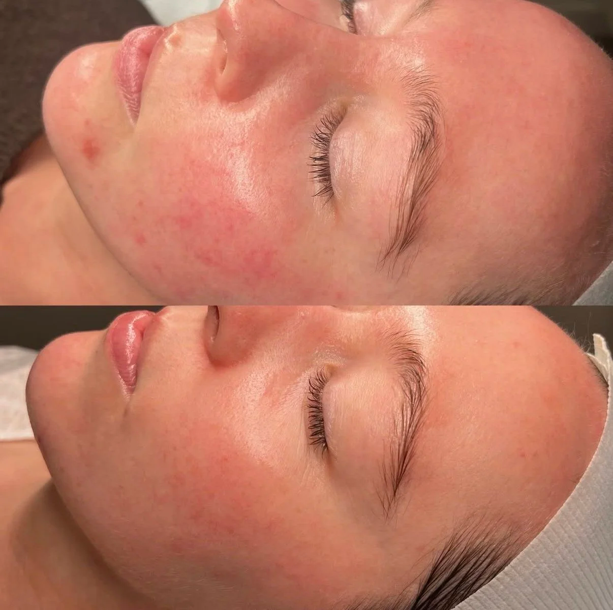Client skin result 5 before and after treatment at Curated Skin Aesthetics