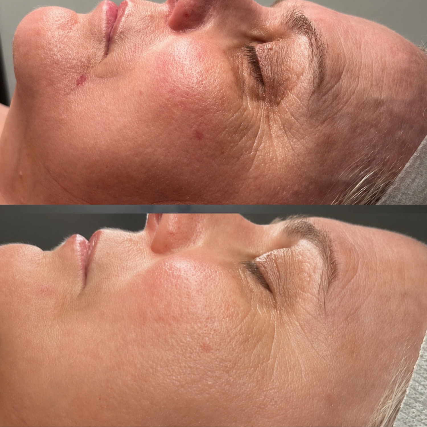 Client skin result 1 before and after treatment at Curated Skin Aesthetics