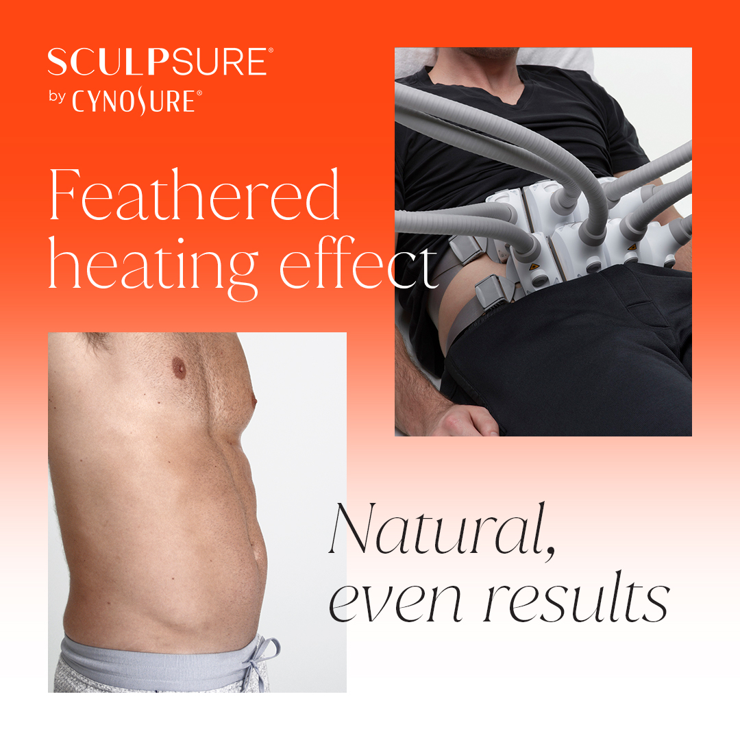 SculpSure is comfortable and safe with minimal side effects SculpSure is comfortable and safe with minimal side effects
