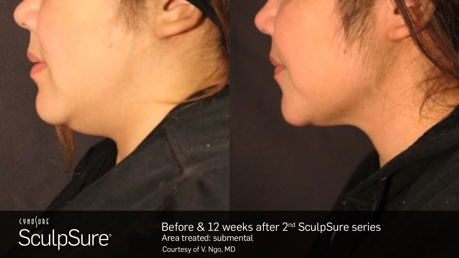 SculpSure chin results showing defined jawline Clifton NJ