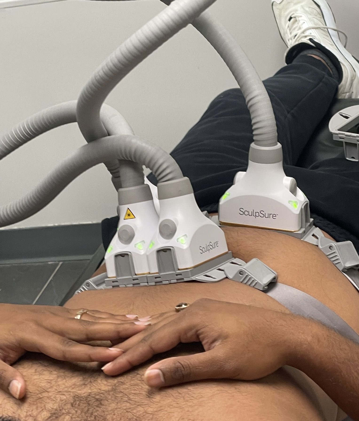 SculpSure laser fat reduction on abdomen Clifton NJ SculpSure laser fat reduction on abdomen Clifton NJ