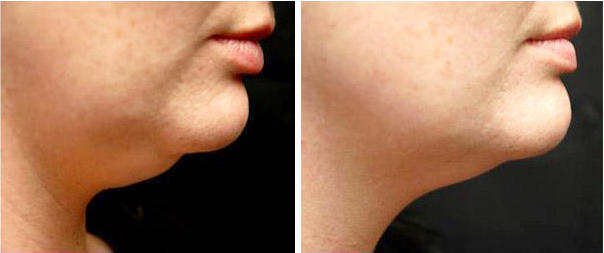 Contour Light Before and After Results