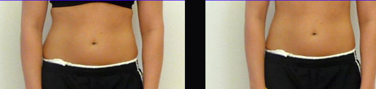 Contour Light Before and After Results