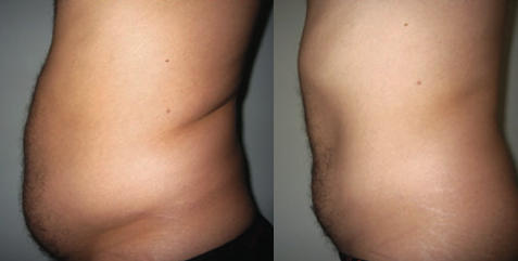 Contour Light Before and After Results