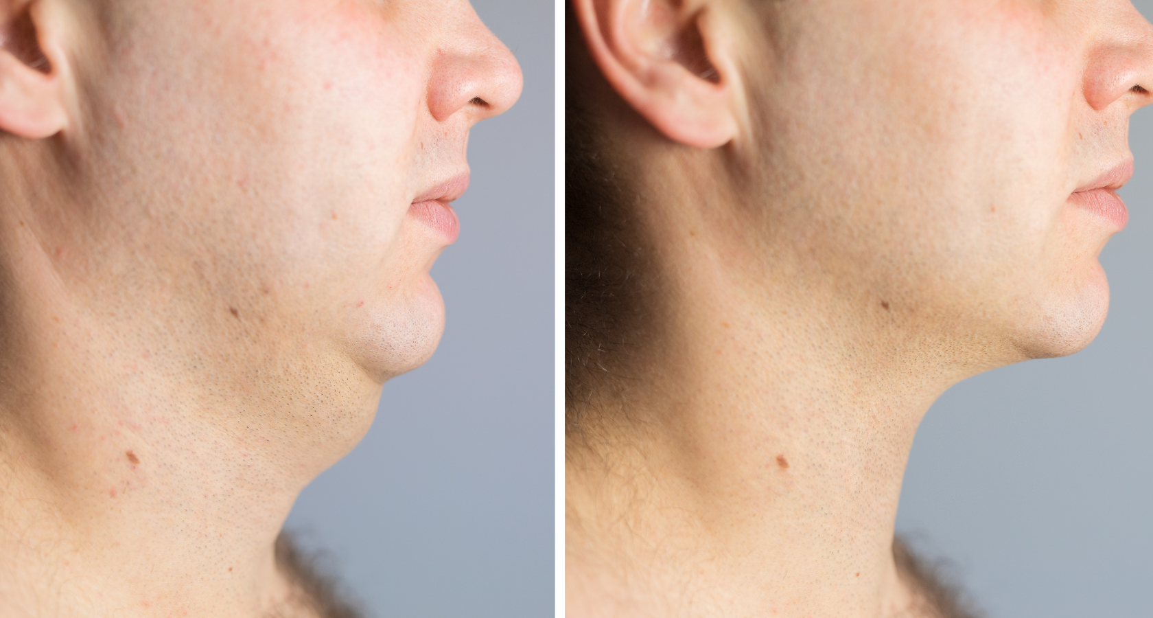Contour Light Before and After Results