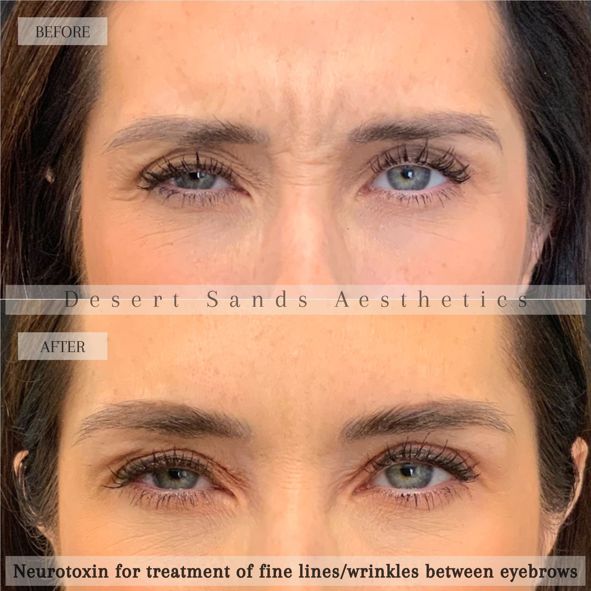 Botox before and after — crow's feet, Desert Sands Aesthetics