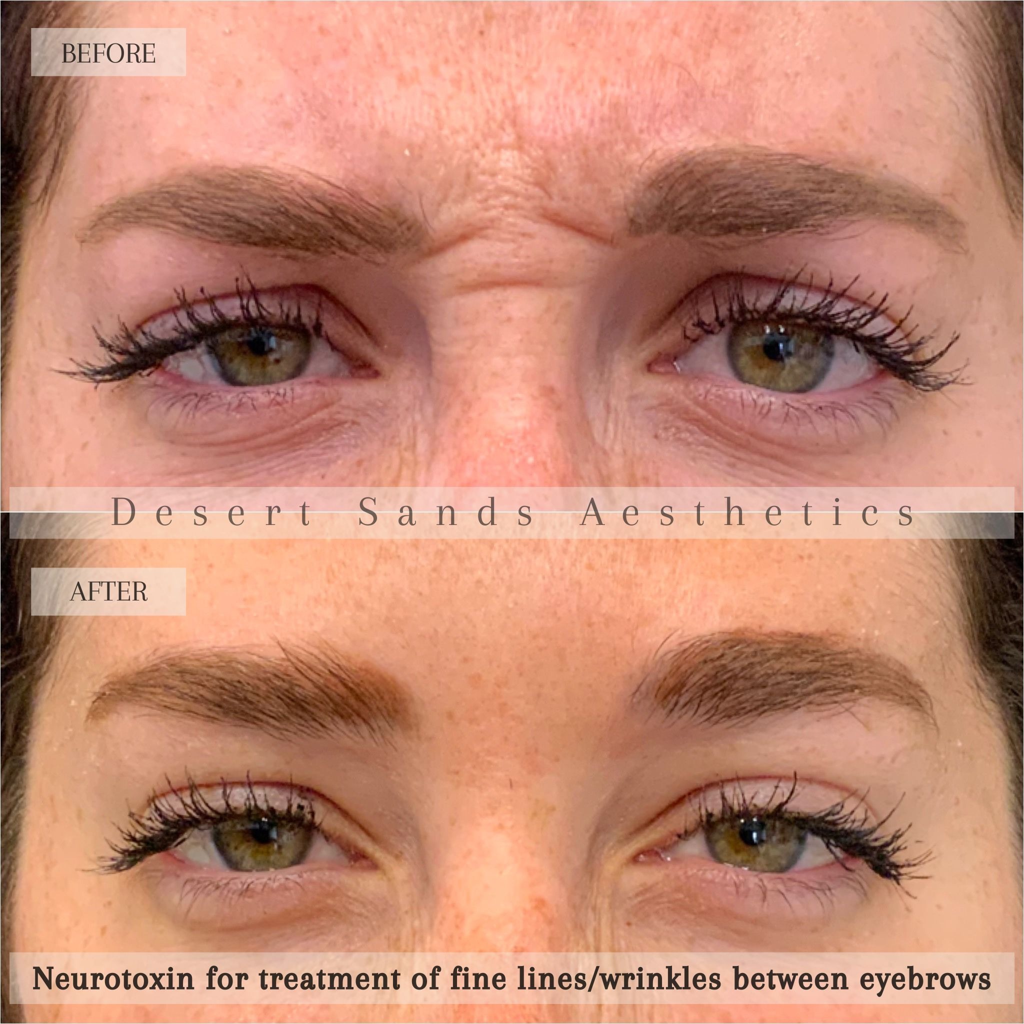 Botox before and after — natural wrinkle reduction, Desert Sands Aesthetics