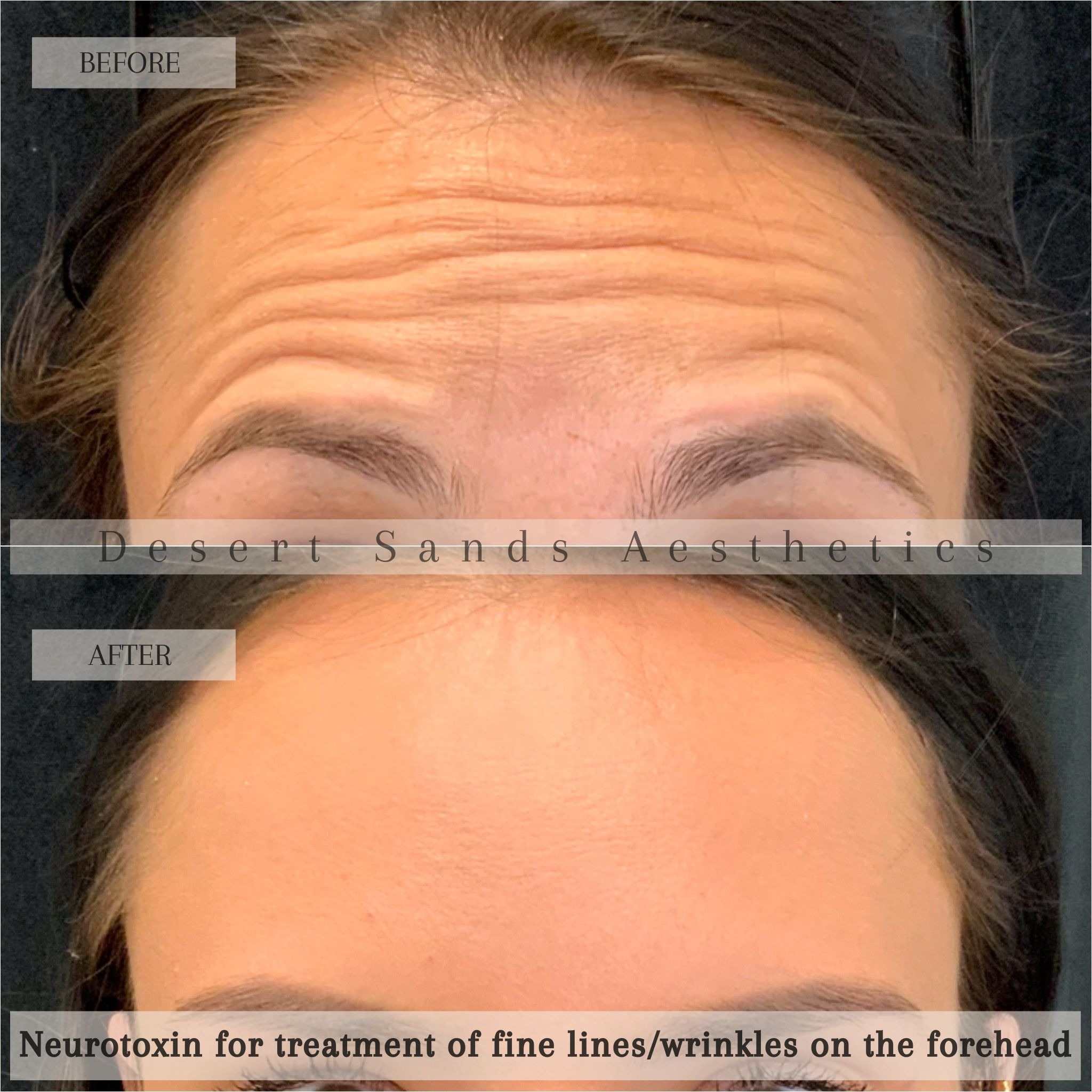 Botox before and after — Desert Sands Aesthetics, St. George Utah