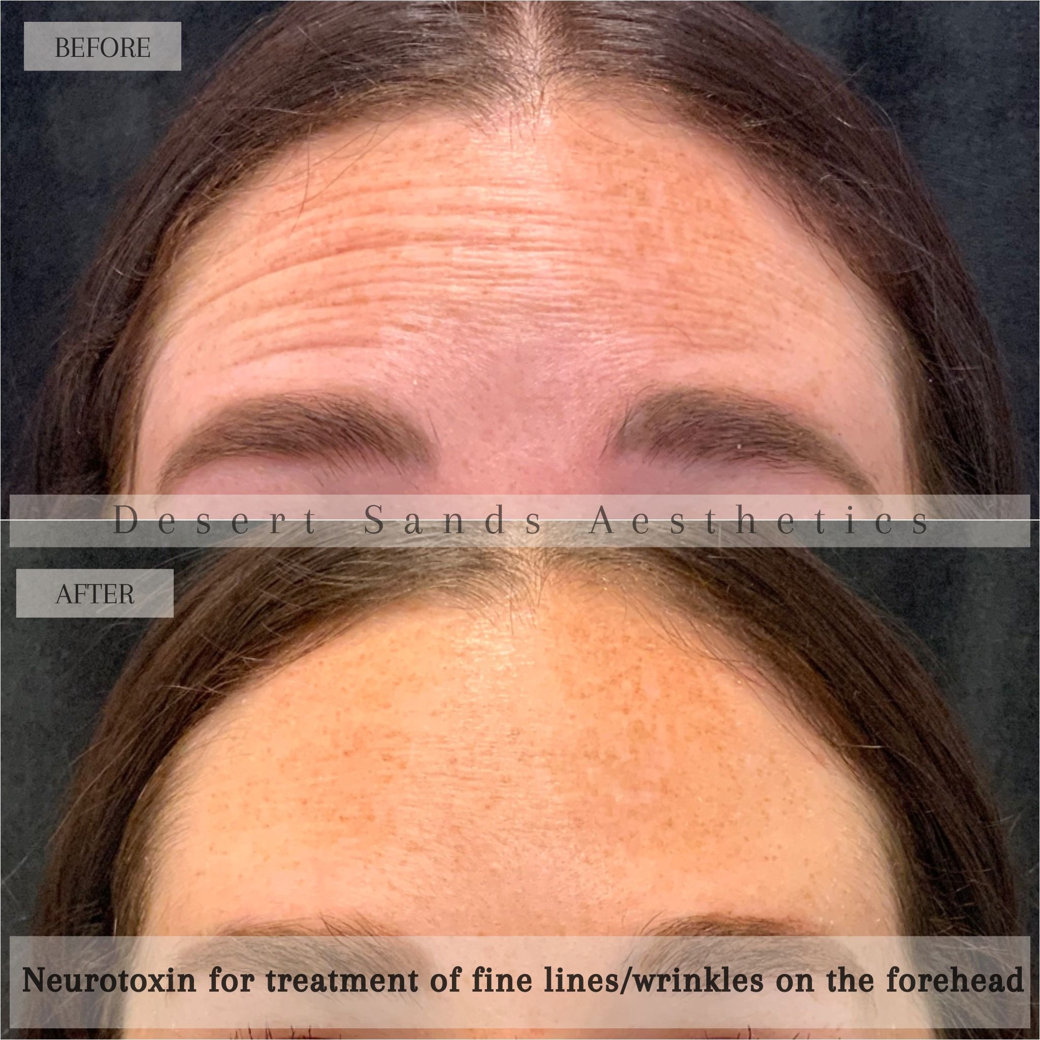 Botox before and after — forehead and glabellar lines, Desert Sands Aesthetics