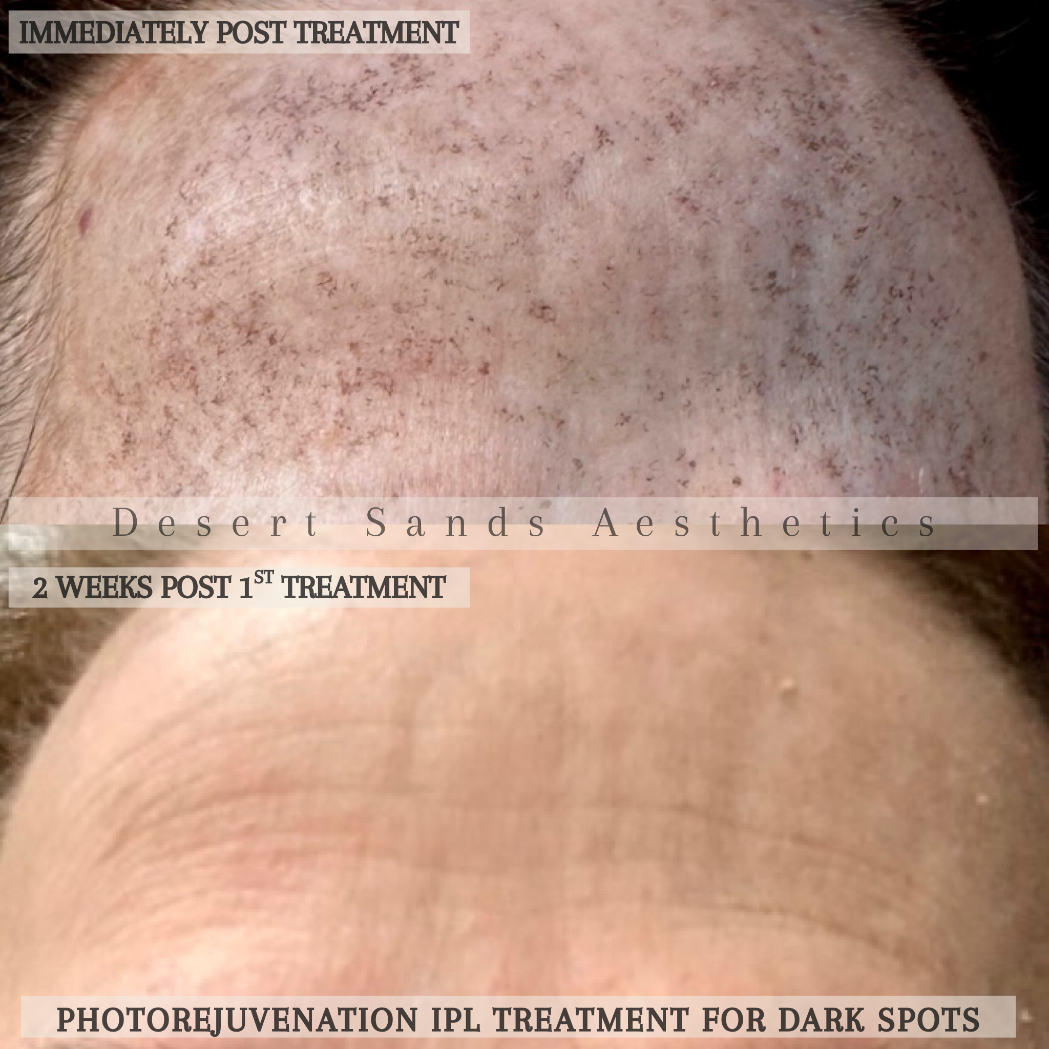IPL photofacial before and after results — Desert Sands Aesthetics & Laser, St. George Utah