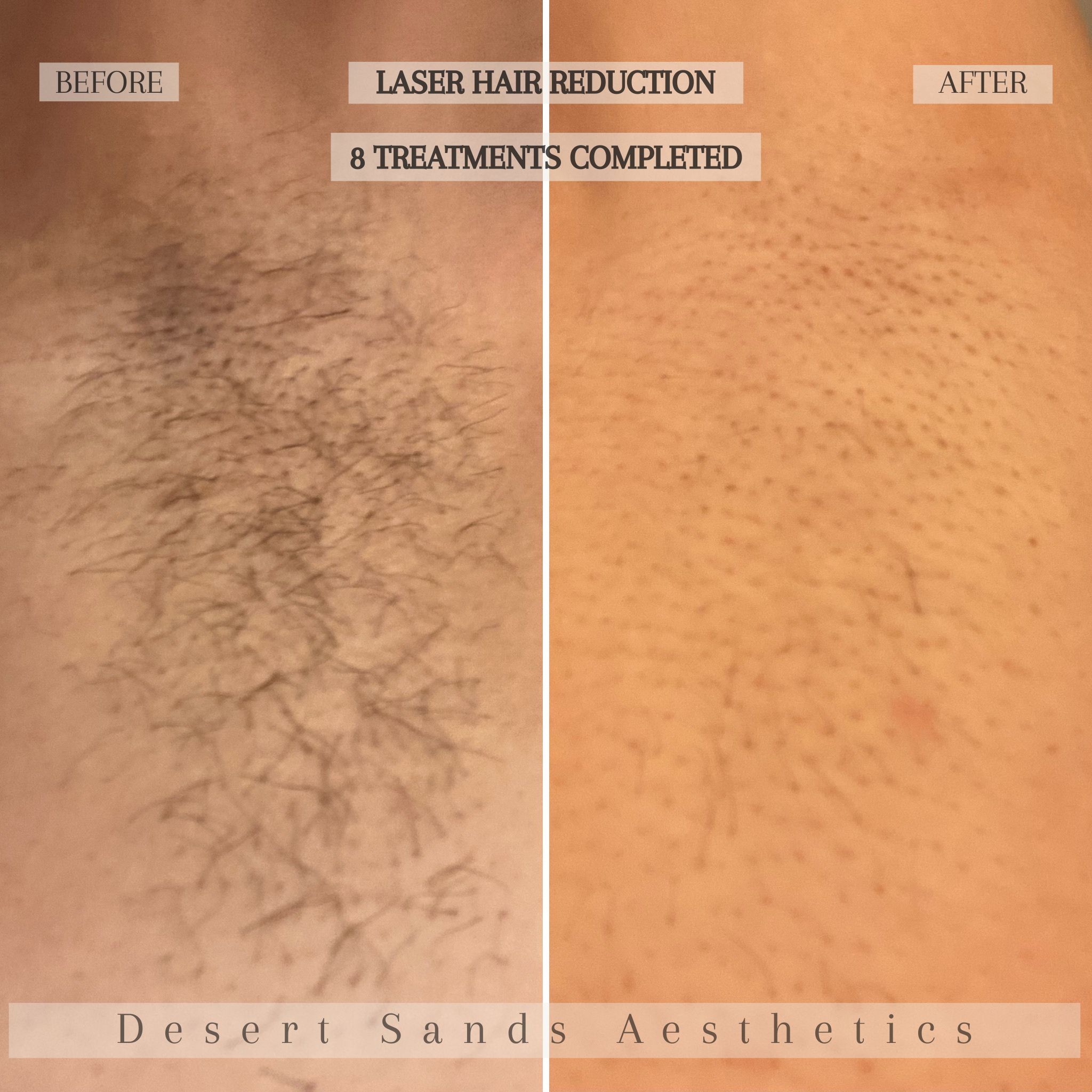 Laser hair removal treatment at Desert Sands Aesthetics & Laser, St. George Utah