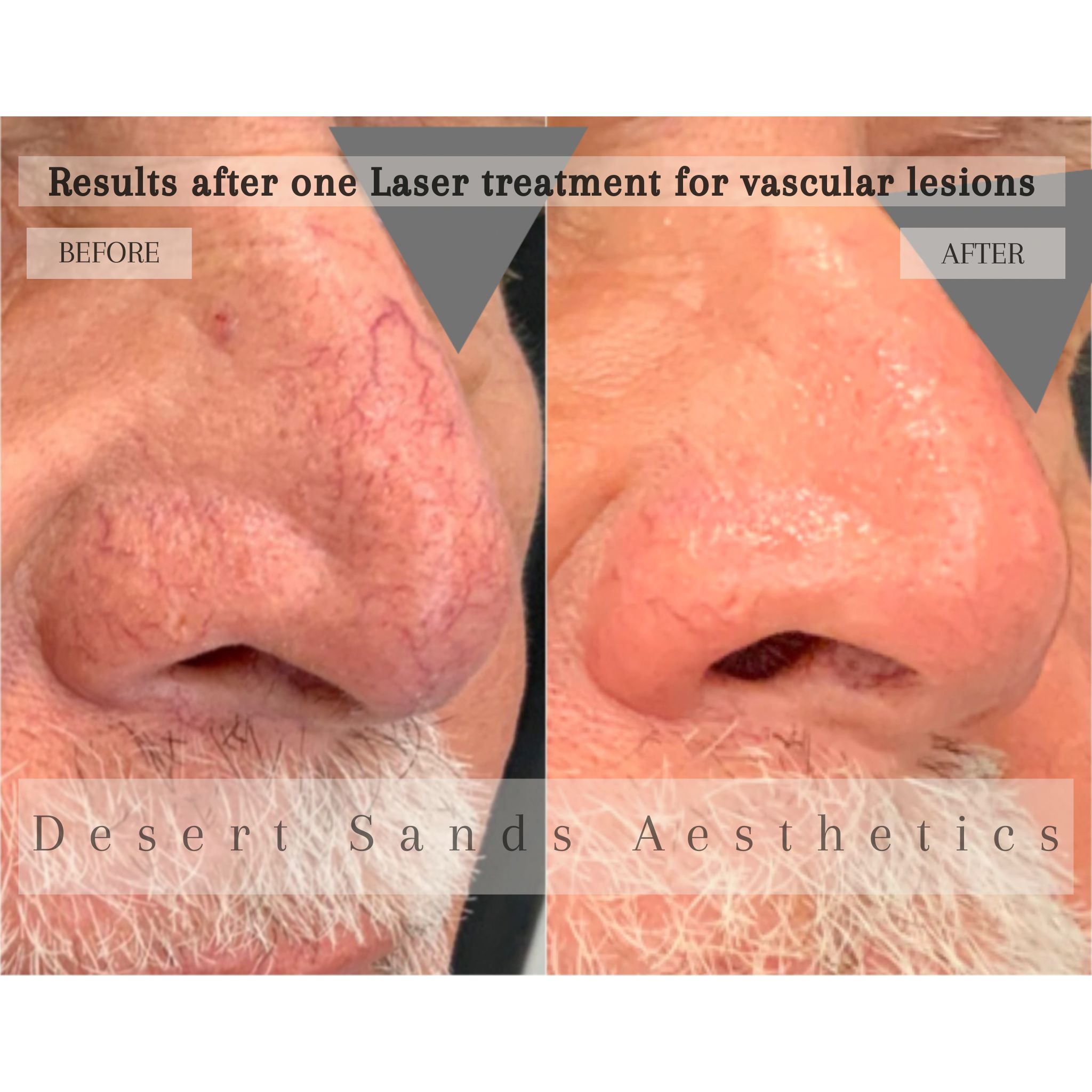 Vascular laser before and after result — Desert Sands Aesthetics & Laser, St. George Utah