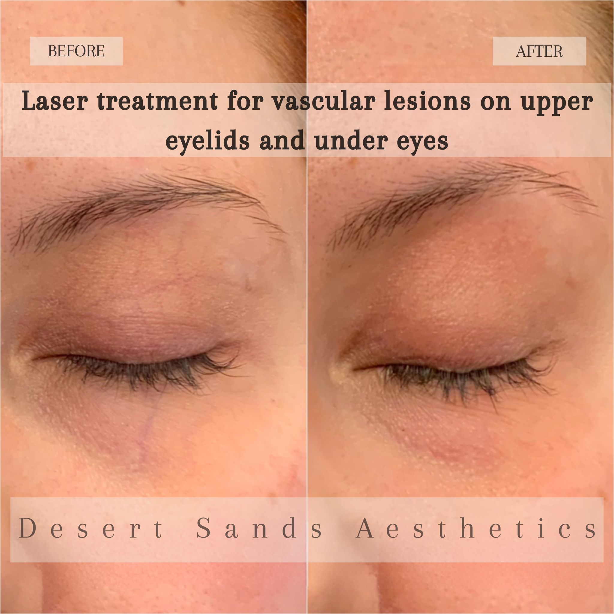 Vascular laser before and after result — Desert Sands Aesthetics & Laser, St. George Utah