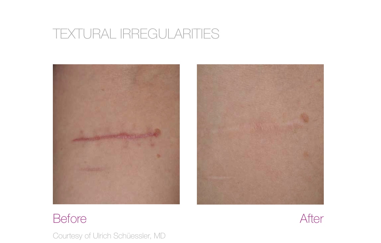 Ellipse Frax 1550 skin resurfacing results at Desert Sands Aesthetics & Laser, St. George Utah