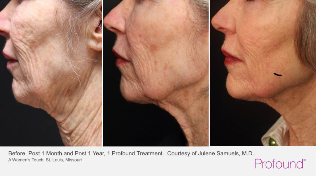 Profound Lift before and after result — patient 2, Desert Sands Aesthetics St. George Utah