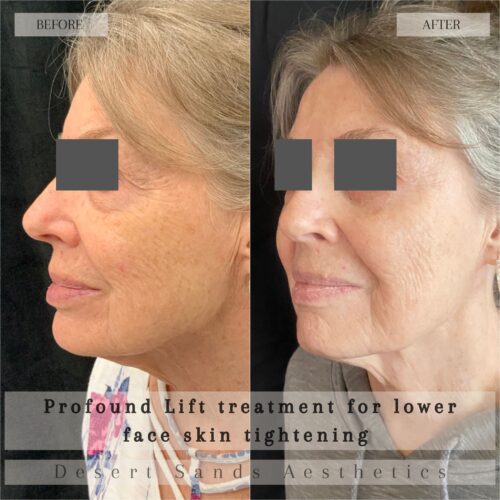 Profound Lift before and after result — patient 1, Desert Sands Aesthetics St. George Utah