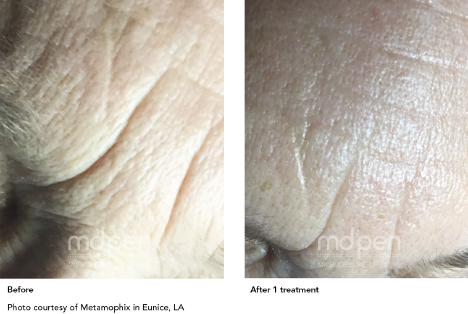 Microneedling before and after results — Desert Sands Aesthetics, St. George Utah