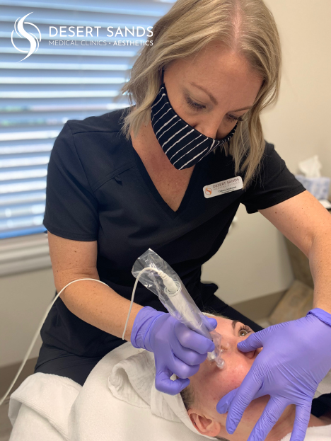 Microneedling treatment at Desert Sands Aesthetics & Laser, St. George Utah
